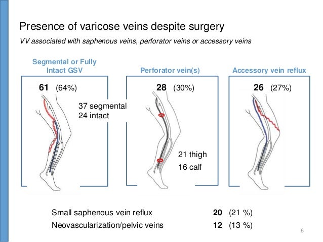 recurrent varicose veins recurrent varicose veins